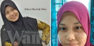 Ada 5 Cara Lenyapkan Blackhead Dan Jerawat Guna Baking Soda